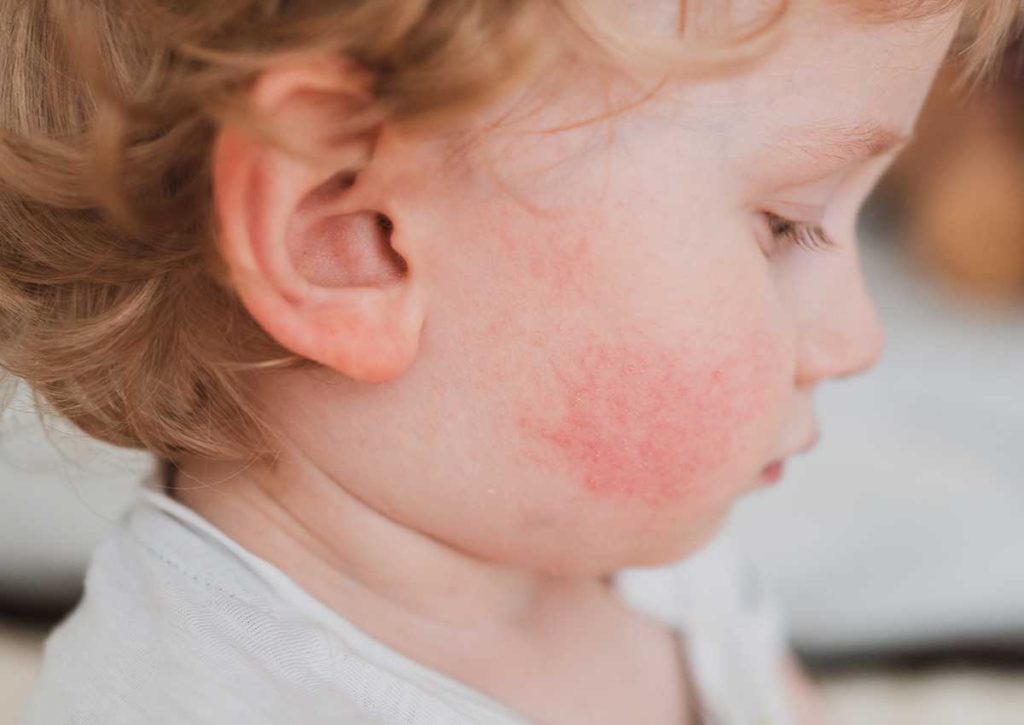 Gérer les allergies alimentaires chez les enfants : astuces pour une vie sereine